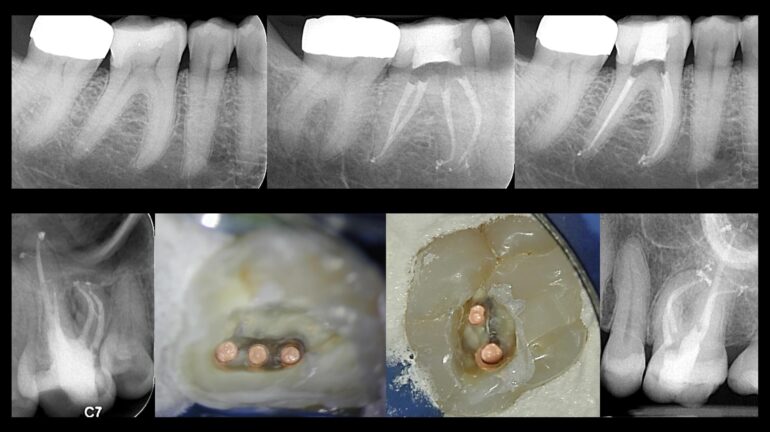 عصب کشی تخصصی