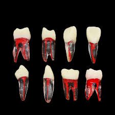 عصب کشی در درمانگاه دندانپزشکی سینا