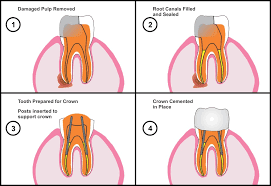 مراحل عصب کشی دندان