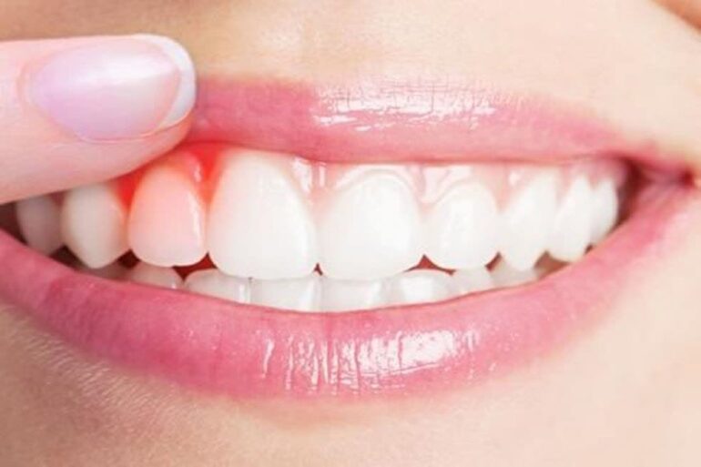 بیماری‌های لثه