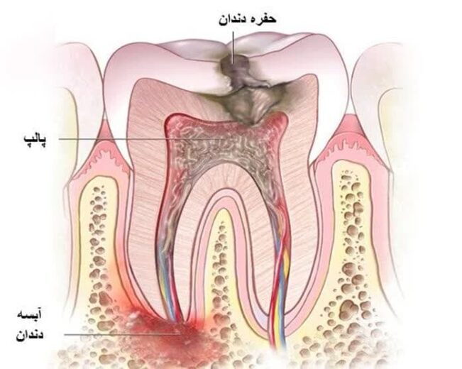 آبسه دندانی