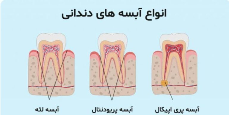 آبسه دندانی