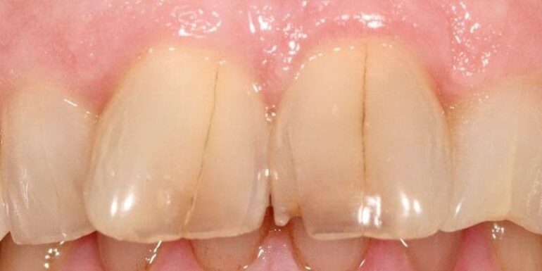 ترک خوردگی دندان