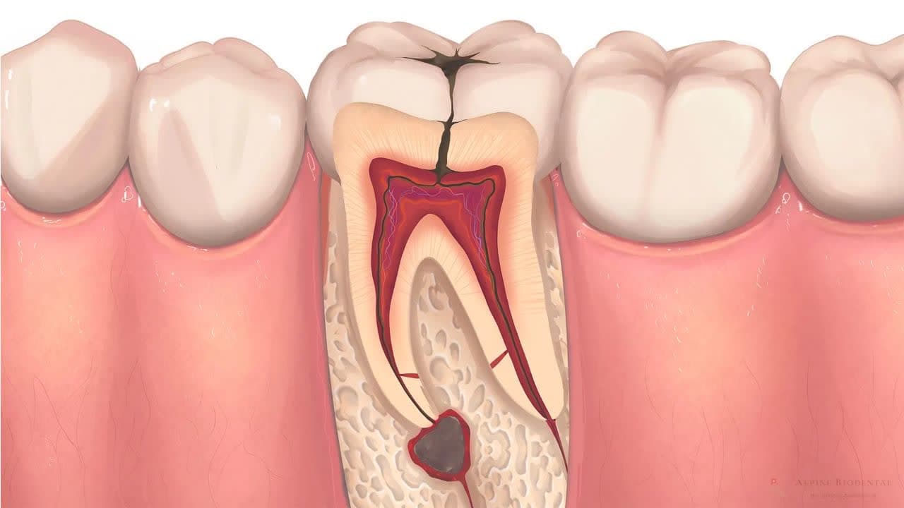 درمان ریشه دندان