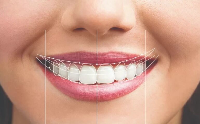 اصلاح طرح لبخند