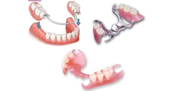 پروتزهای متحرک