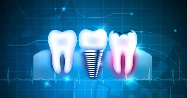 مراقبت بعد از ایمپلنت دندان