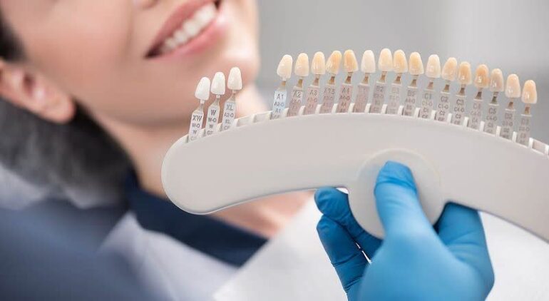 مراقبت پس از لمینت دندان