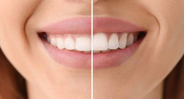 مراقبت پس از جراحی لثه