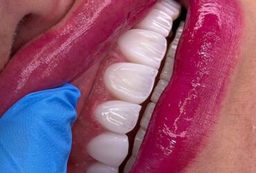 عکس کامپوزیت دندان جلو