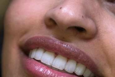 عکس یک واحد دندان