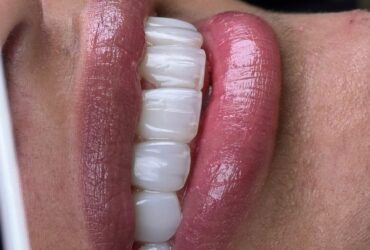 هزینه کامپوزیت دندان چیست