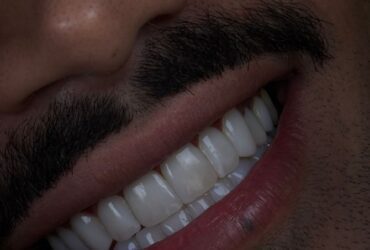 کامپوزیت دندان مردانه