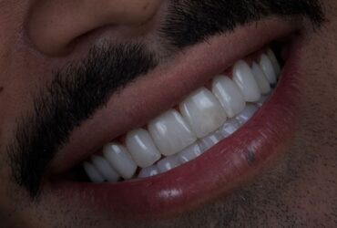 قیمت کامپوزیت کل دندان ها