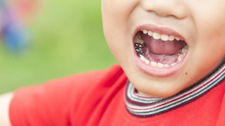 پوسیدگی دندان شیری