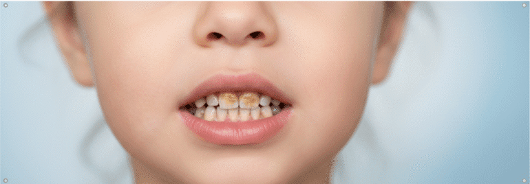 جرم دندان اطفال