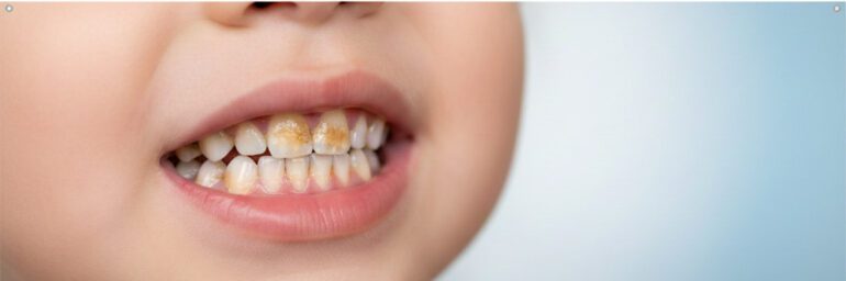 جرم دندان اطفال